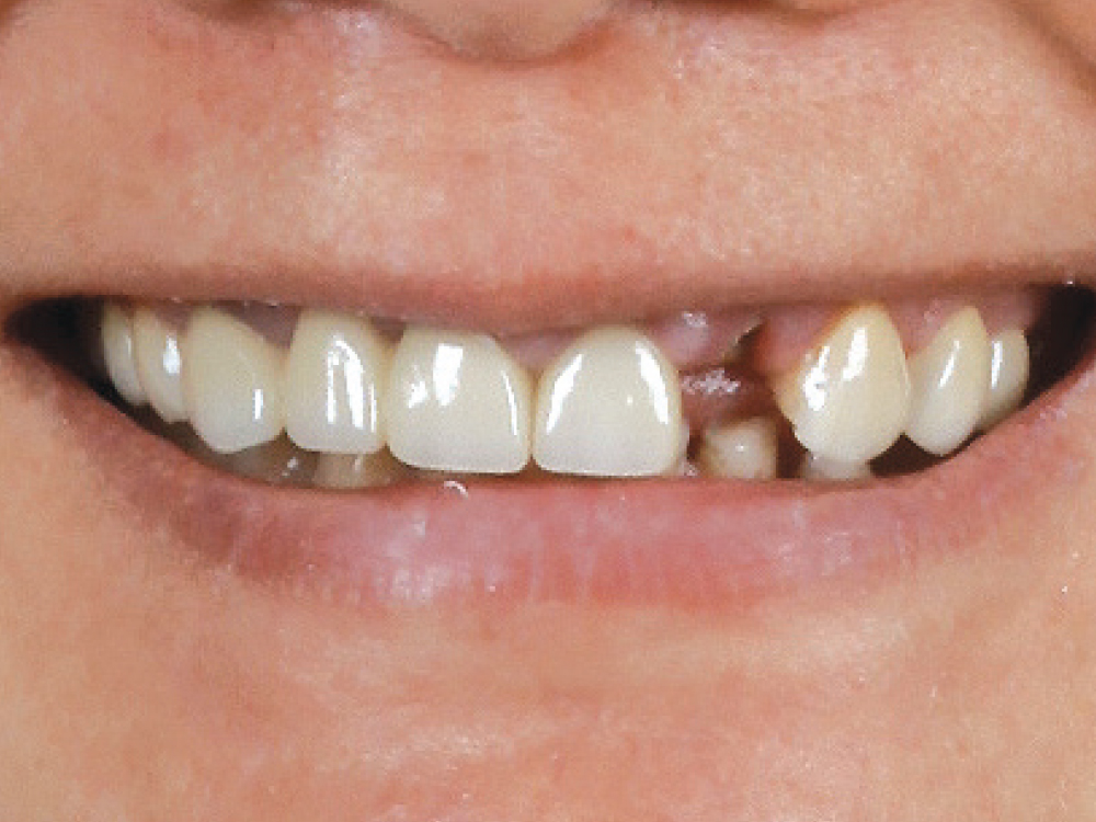 Close up of missing frontal tooth