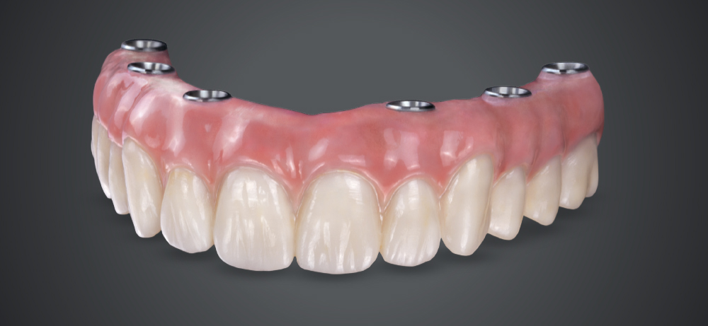 A dental implant