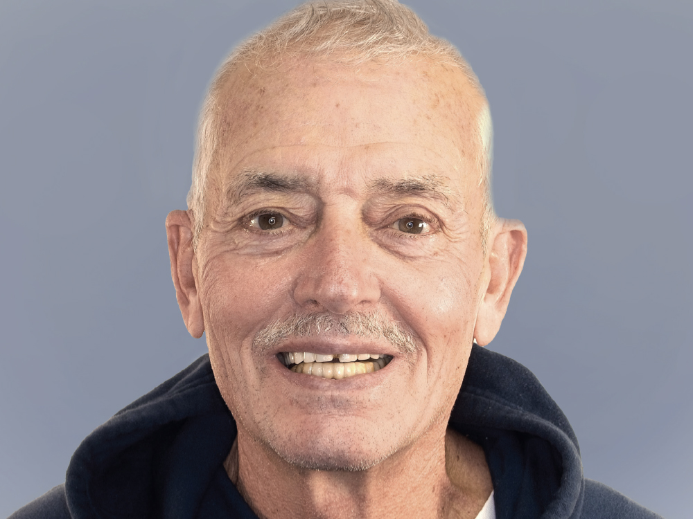 Before: Patient with troublesome denture that affected chewing ability