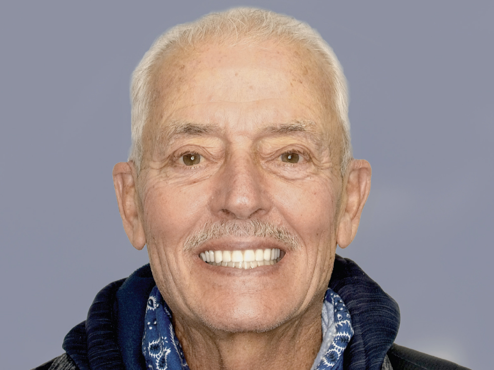 After: Patient with implants on upper jaw and connected to full-mouth BruxZir restoration
