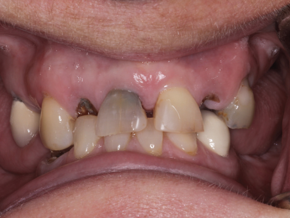 Before: Uneven teeth that causes discomfort