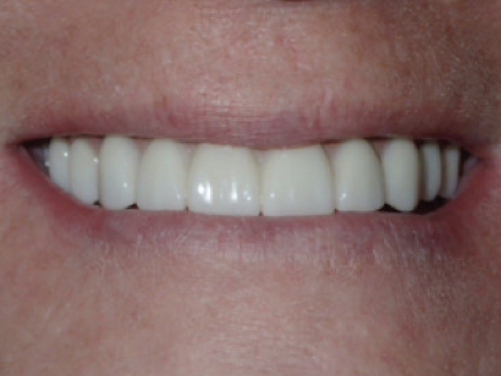 After: An improved smile after implants and dental restorations