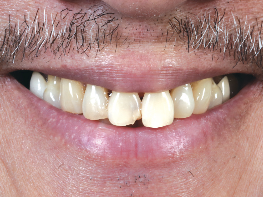 Before: Uneven smile from natural teeth
