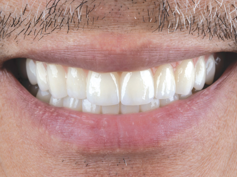 After: Full-mouth dental restoration attached