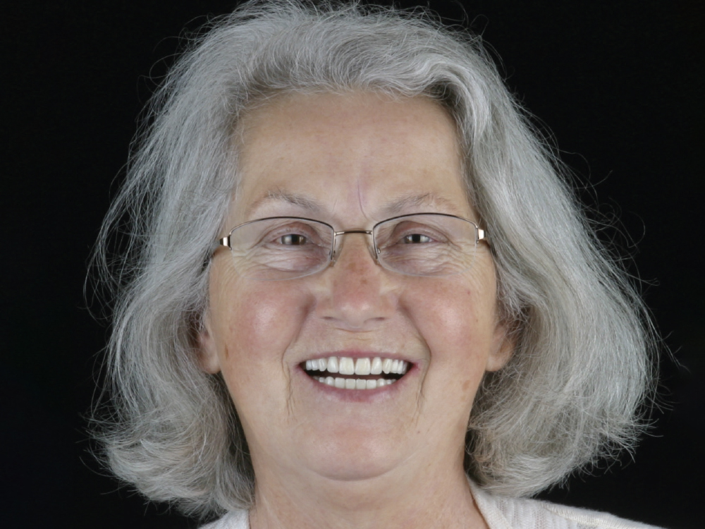 After: Patient with a new smile done by BruxZir restoration