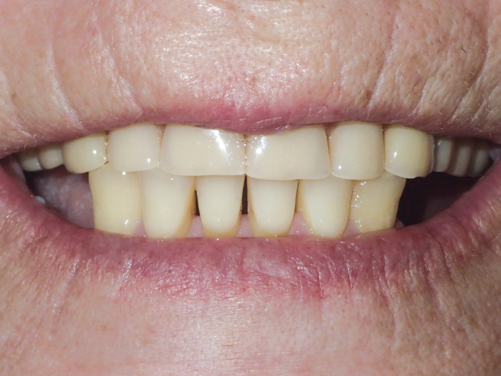 Before: A discolored, worn-down denture
