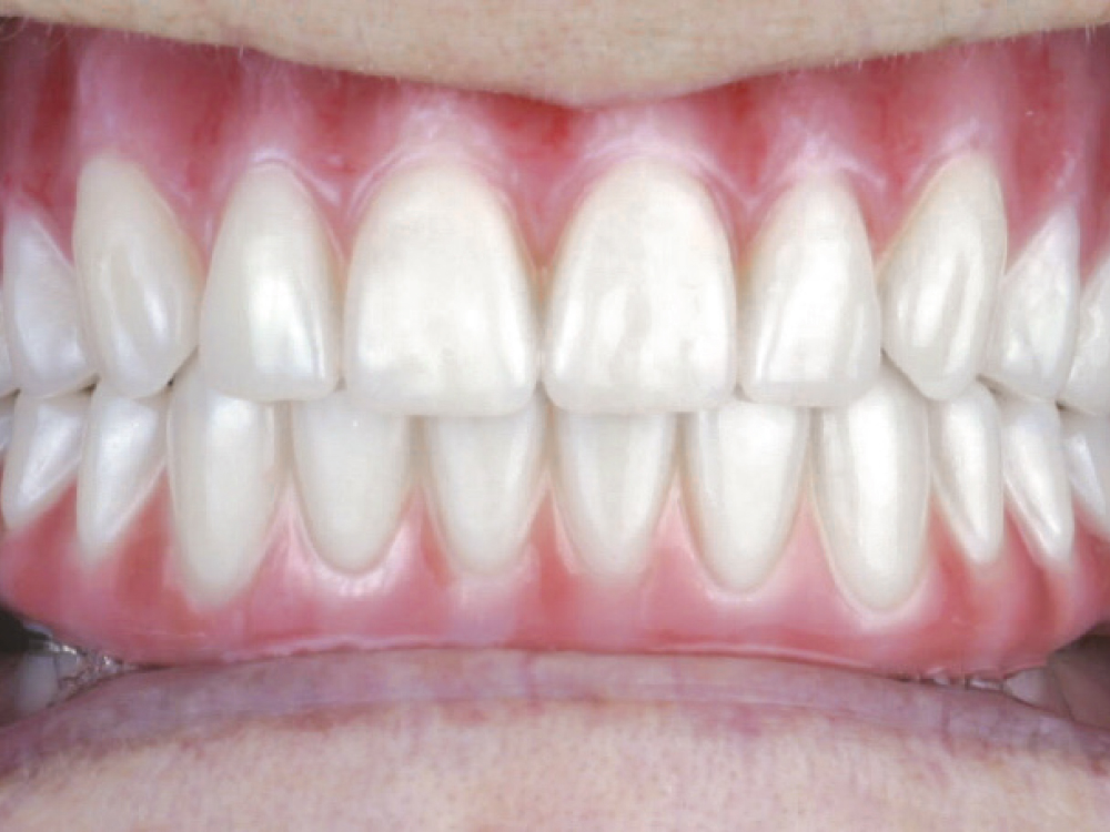 After: A whitened implant with BruxZir Zirconia restorations