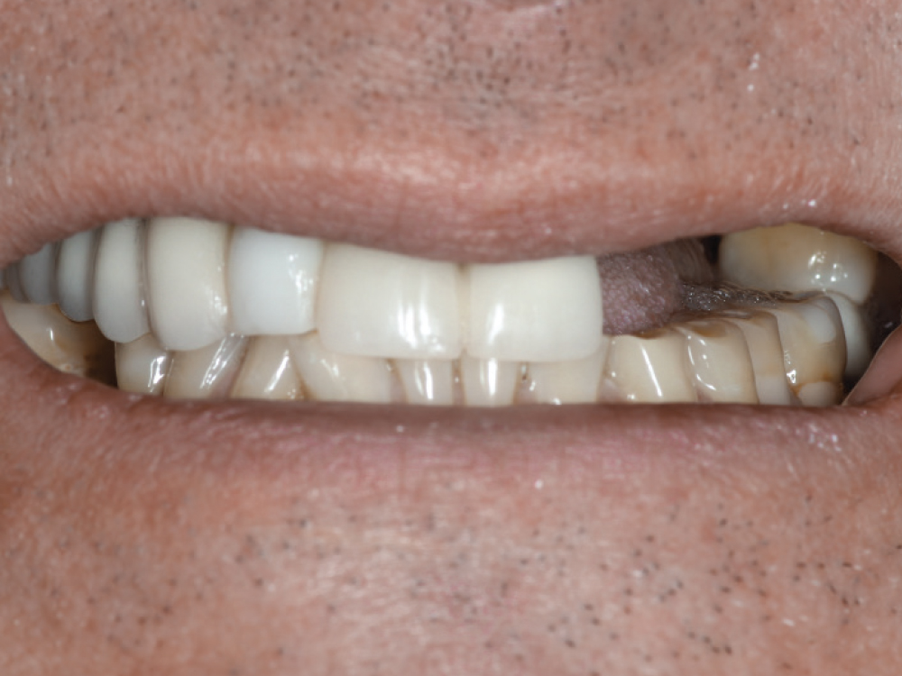 Before: A broken dental bridge without teeth on upper left side