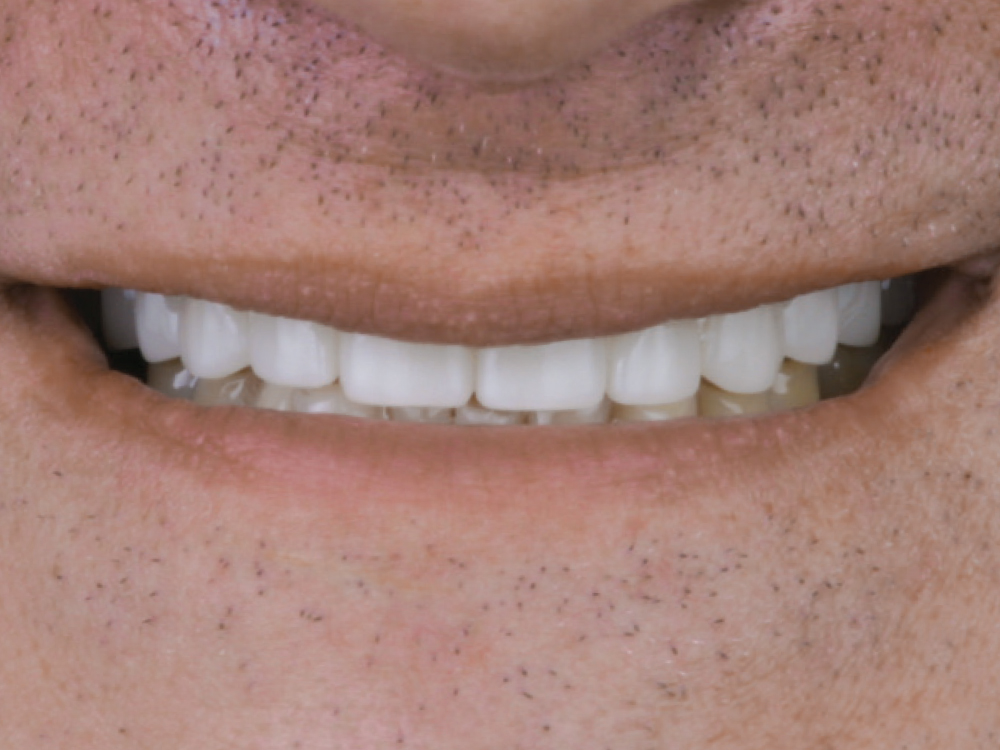 After: Teeth replaced using implants and full-mouth restoration