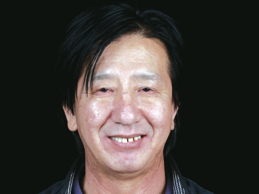 Before: Patient with uneven smile