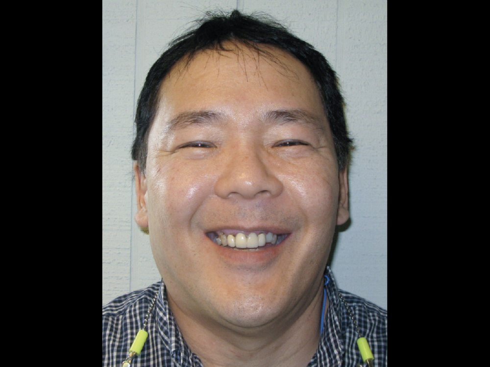 Before: Patient with a crooked smile after multiple failed restorations