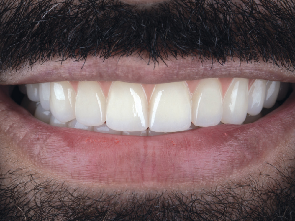 After: Improved teeth with full-mouth dental implants