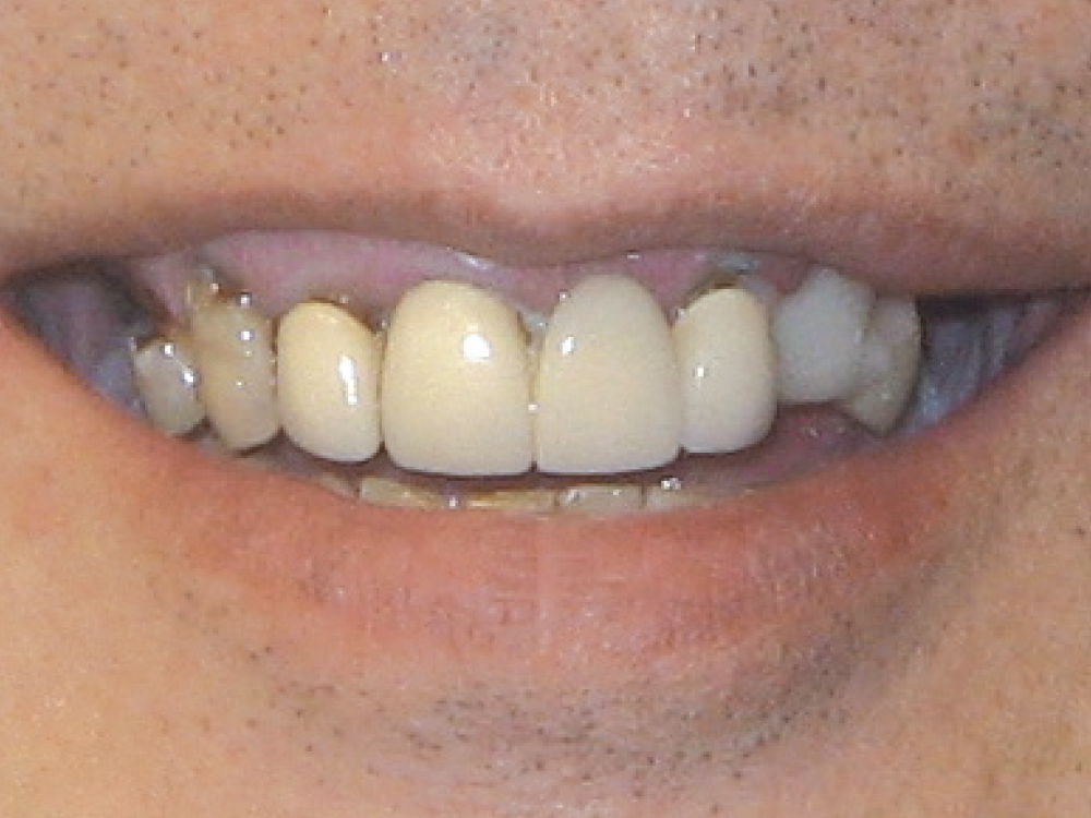 Before: Teeth with multiple restorations failed