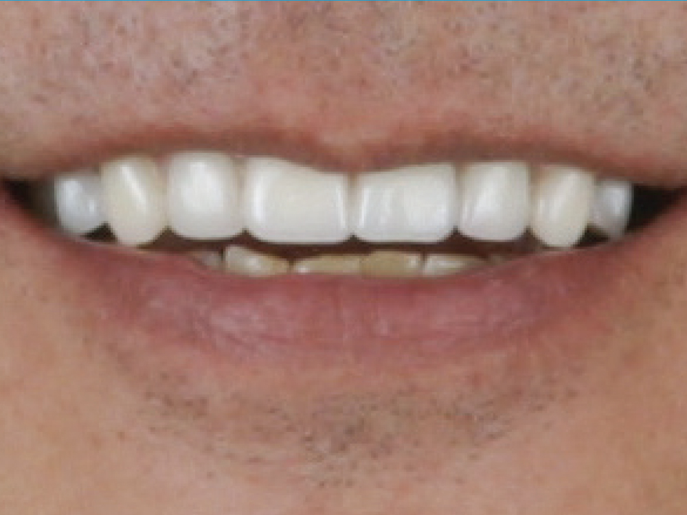 After: Teeth done with stable implants and a BruxZir full-mouth restoration