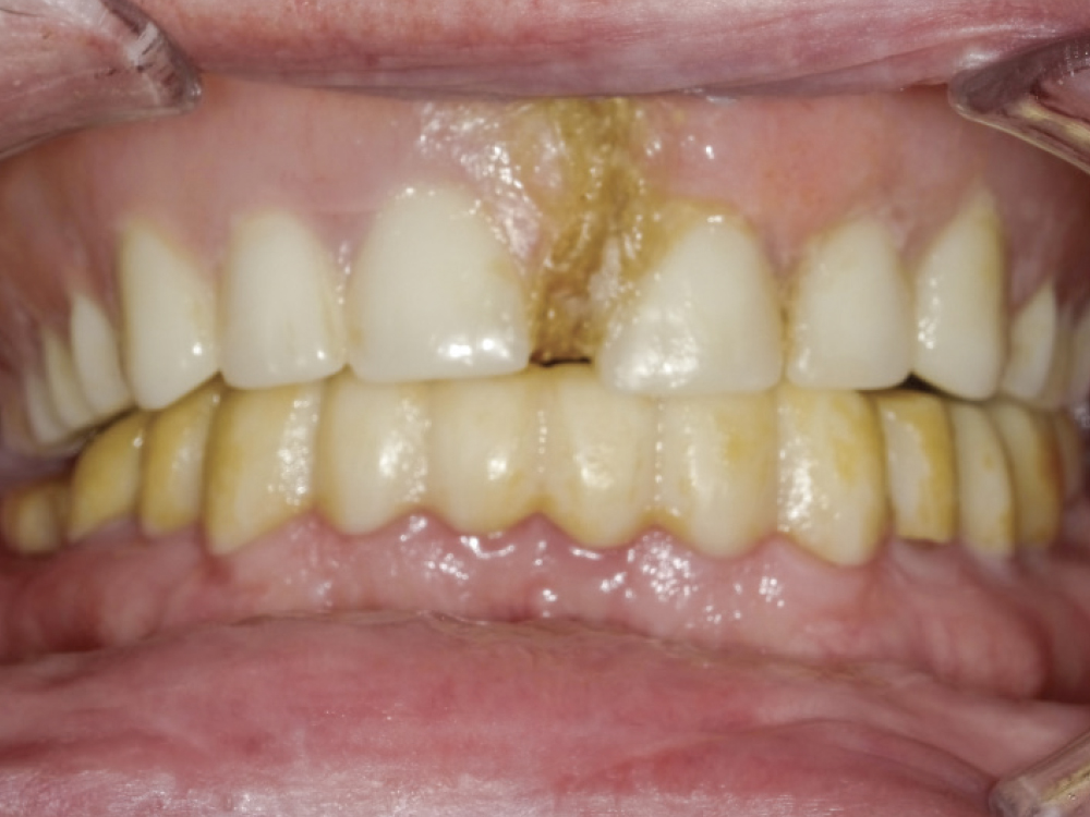 Before: Teeth with a broken denture