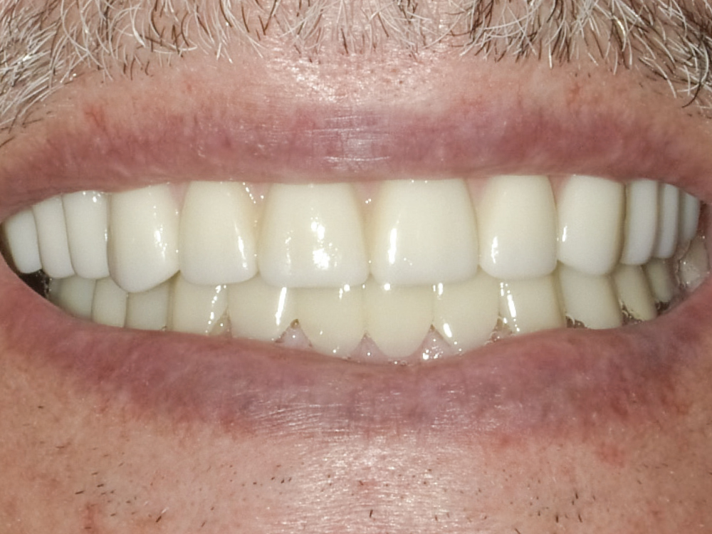 After: Improved teeth with implant on upper jaw and full-mouth BruxZir restoration