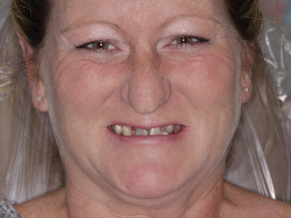 Before: Patient with teeth that causes discomfort