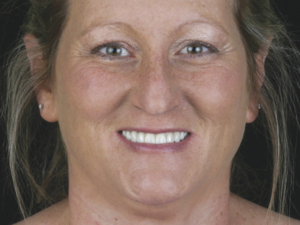 After: Patient with perfect teeth from implants and dental restorations
