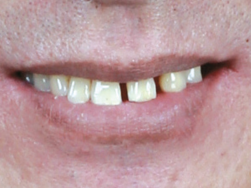 Before: Crooked teeth