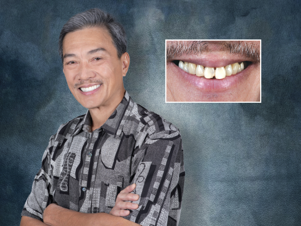 The Best Solution for Patients with Missing Teeth