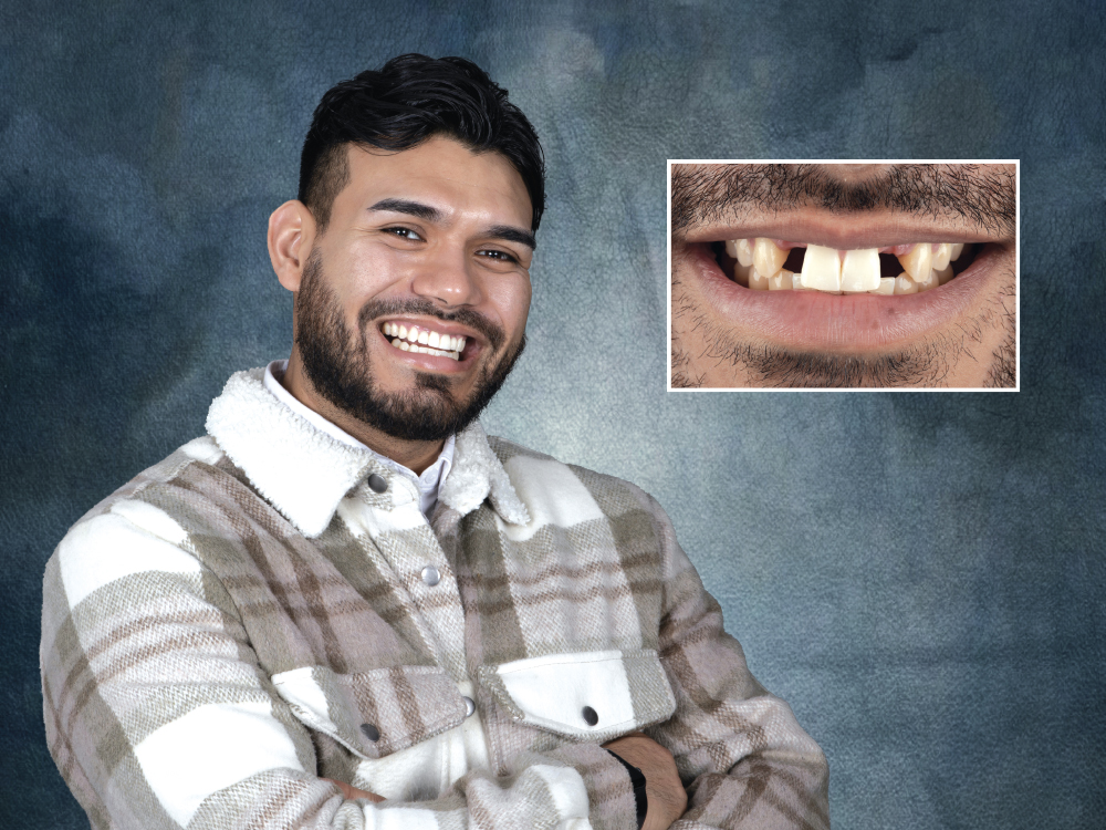 Omar after receiving implants to replace is missing upper lateral incisors