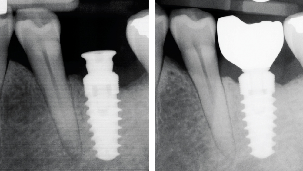 Implant x-ray