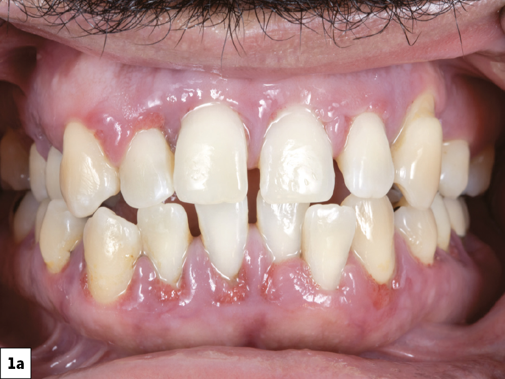 Figure 1a: Patient mouth with stage IV periodontitis 