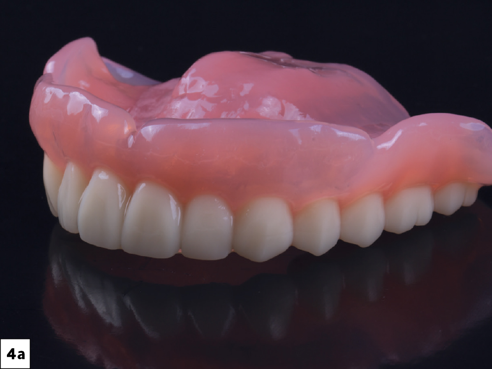 Figure 4a: Simply Natural 3D-printed dentures