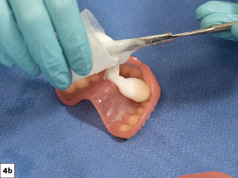 Figure 4b: Relining Simply Natural 3D-printed dentures with conditioner
