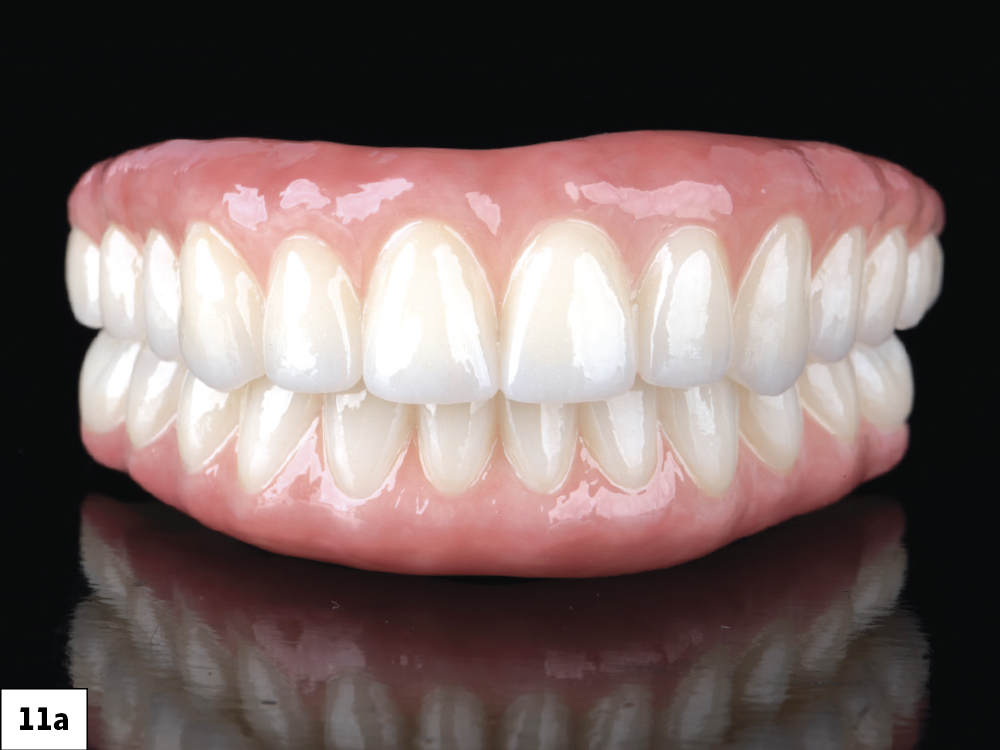 Figure 11a: Milled BruxZir Esthetic Implant Prosthesis