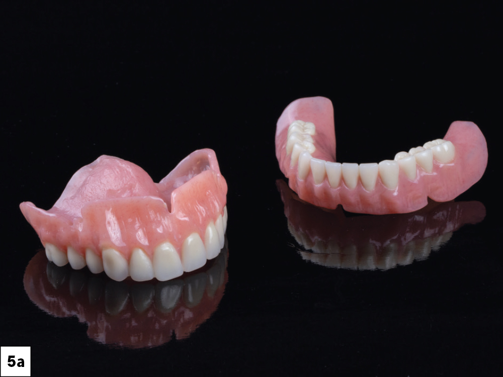 Figure 5a: Dentures to help plan for final restorations