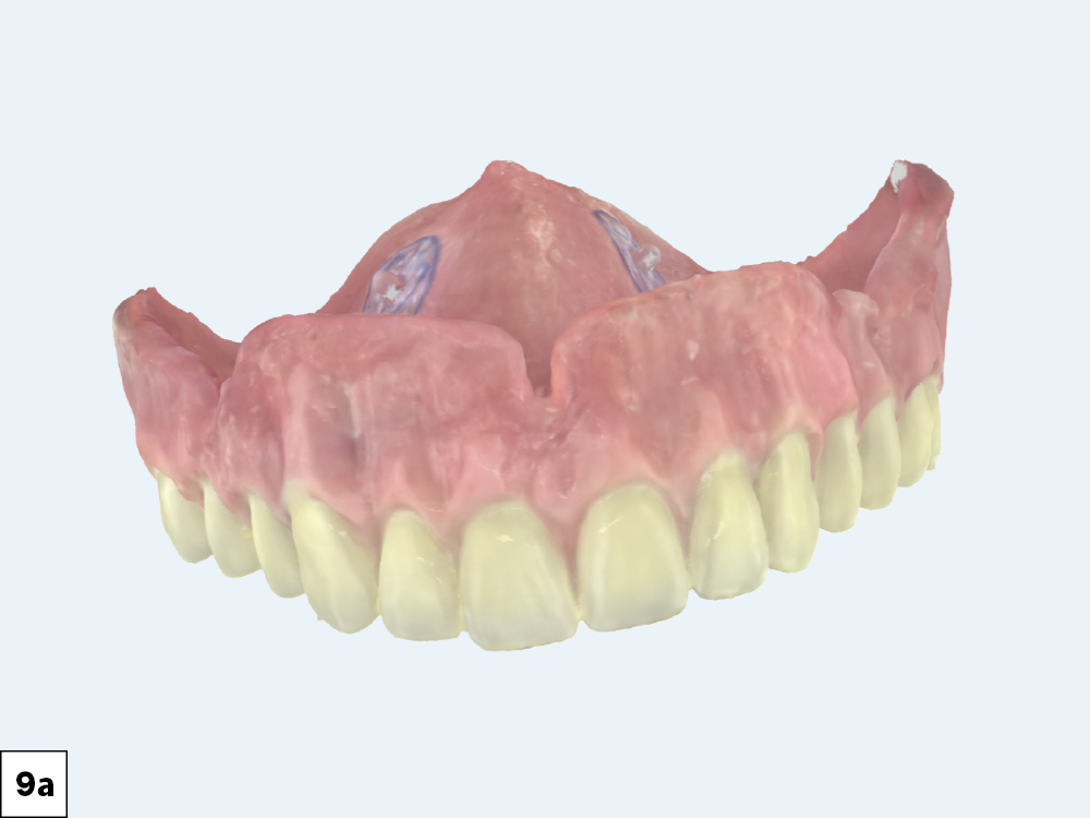 Figure 9a: Digital scans of definitive dentures