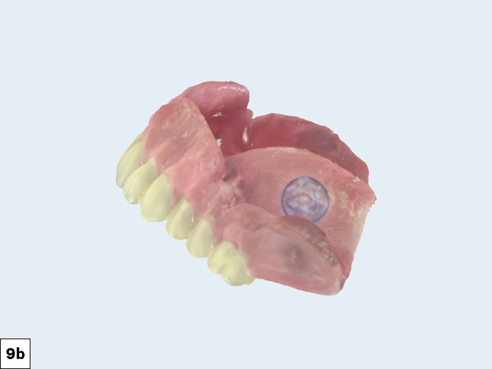 Figure 9b: Digital scans of definitive dentures
