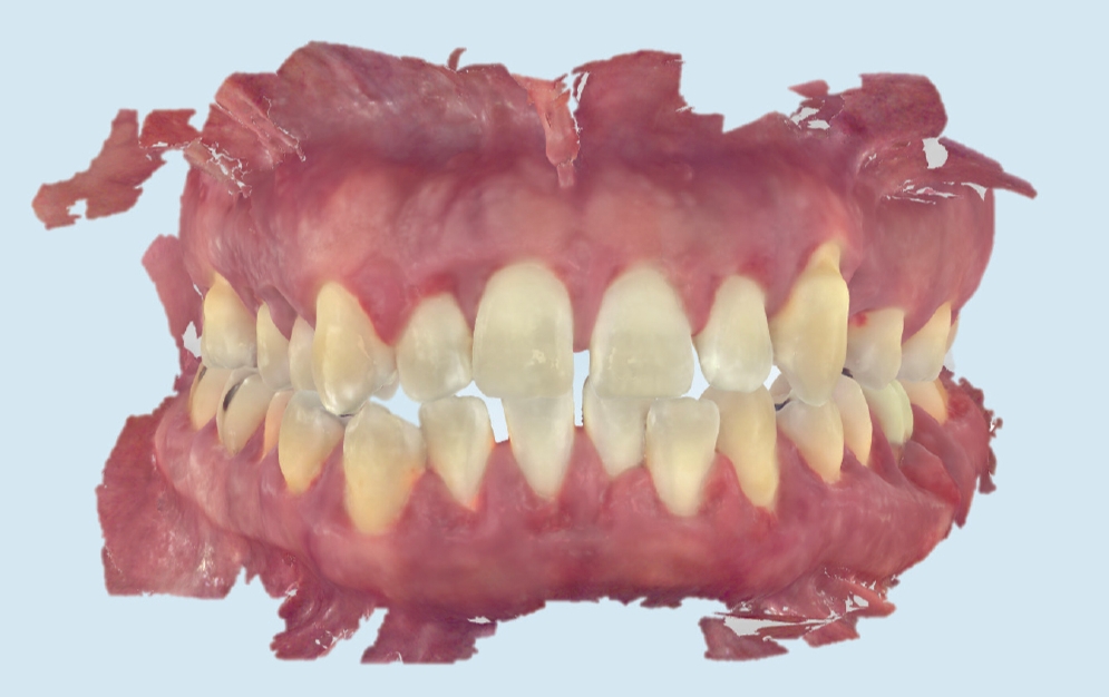 Intraoral scan of patient mouth