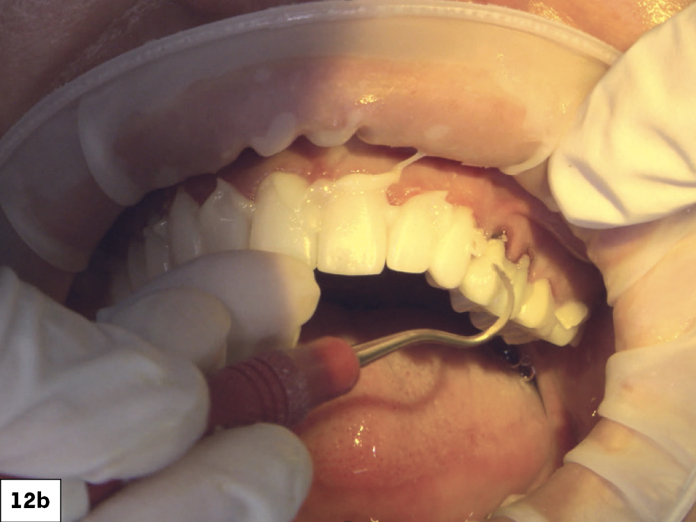 Figure 12B: Bonding final crowns in patient mouth