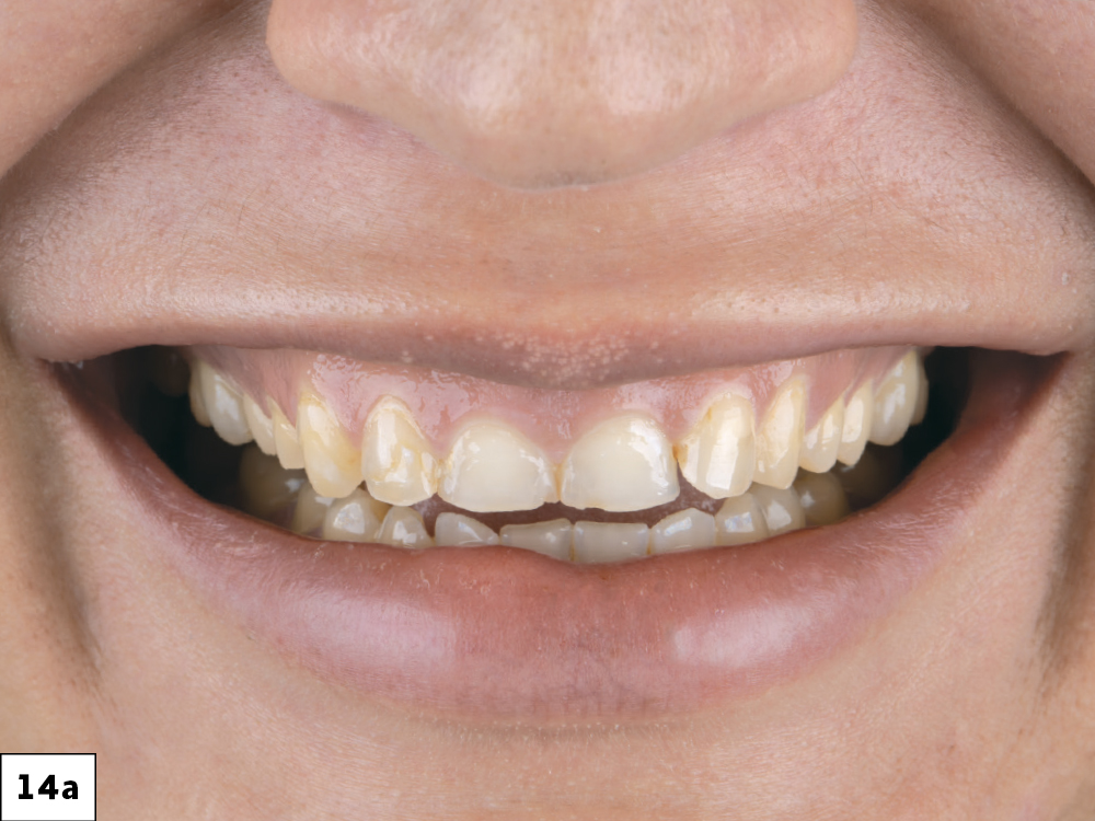 Figure 14A: Patient smile before restoration