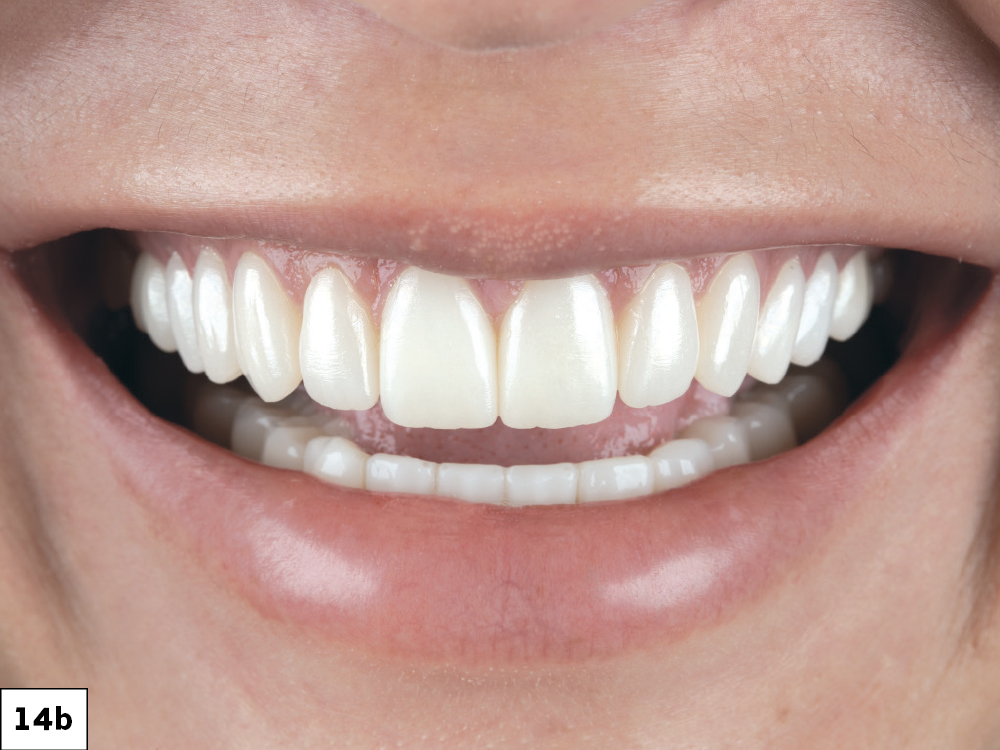 Figure 14B: Patient smile after restoration