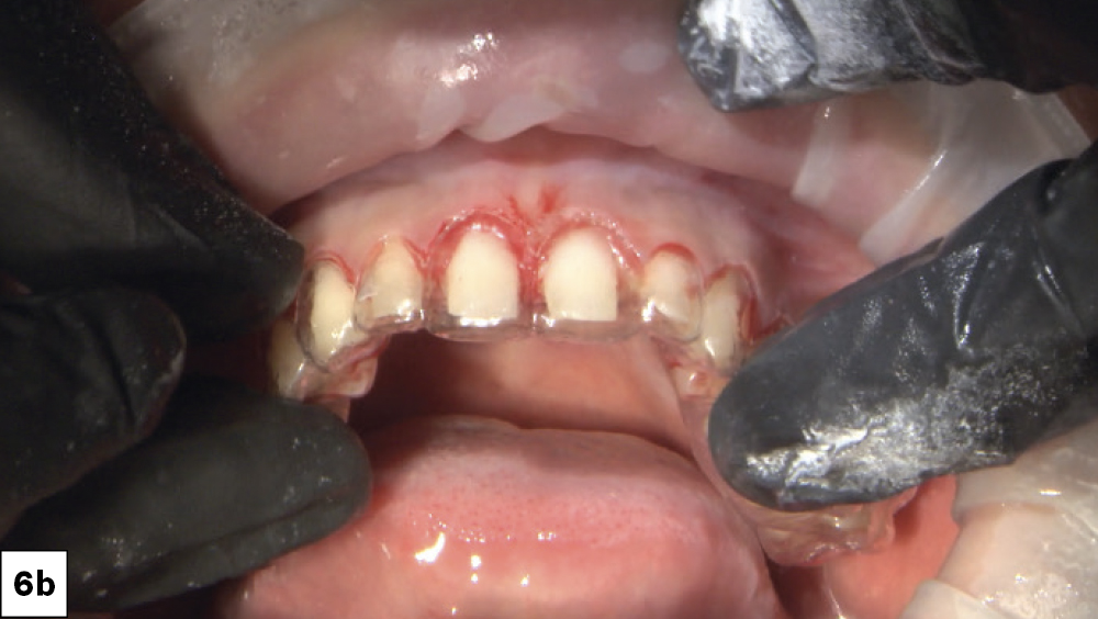 Figure 6b: Establishing clearance while reducing the teeth