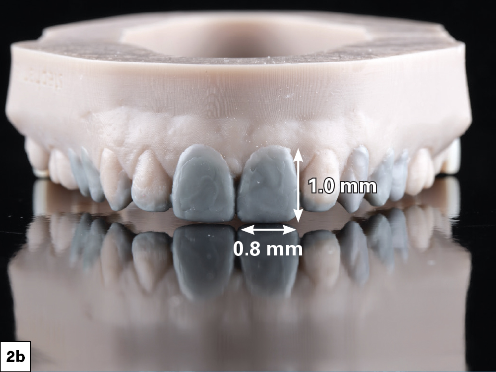 Figure 2B: Diagnostic wax-up of patient mouth
