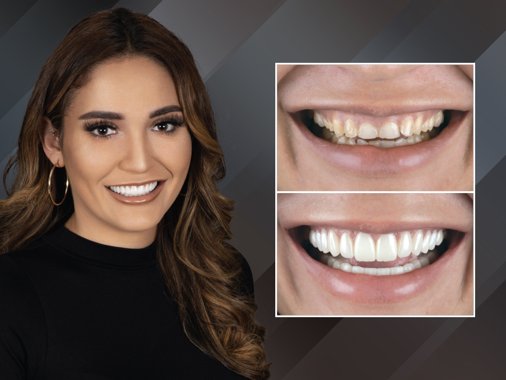 Patient before and after digitally-designed restorations