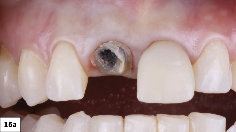 Figure 15A: Patient mouth before immediate implant surgery