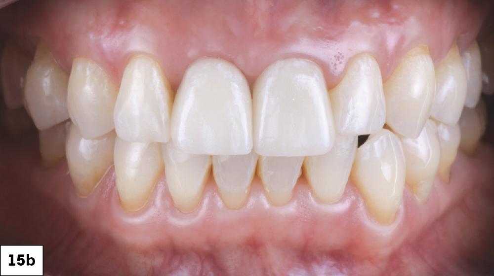 Figure 15B: Patient mouth after immediate implant surgery