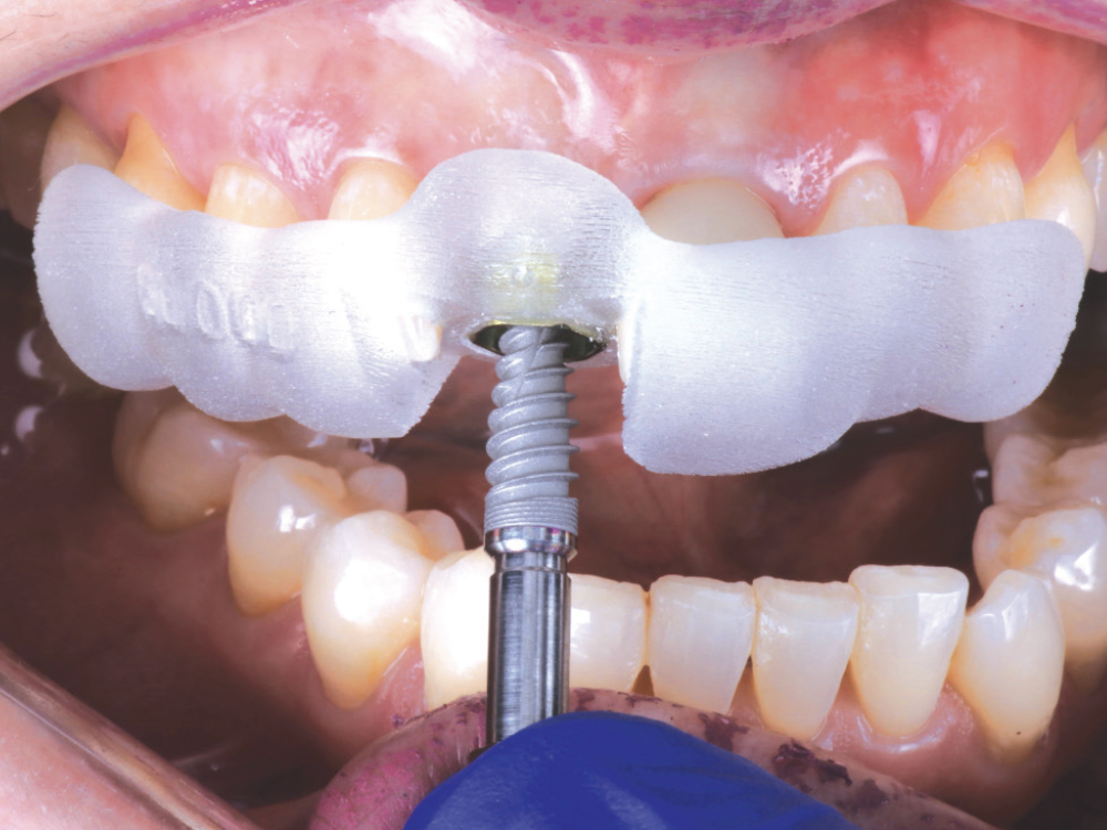 Figure 9: Hahn implant inserted via surgical guide