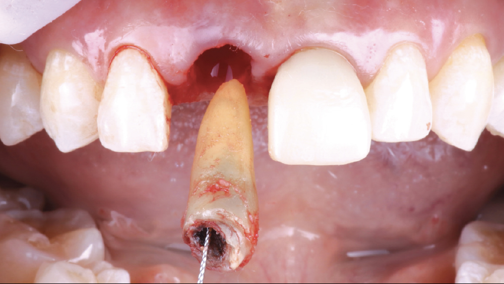 Figure 5: Tooth and entire root extracted from mouth