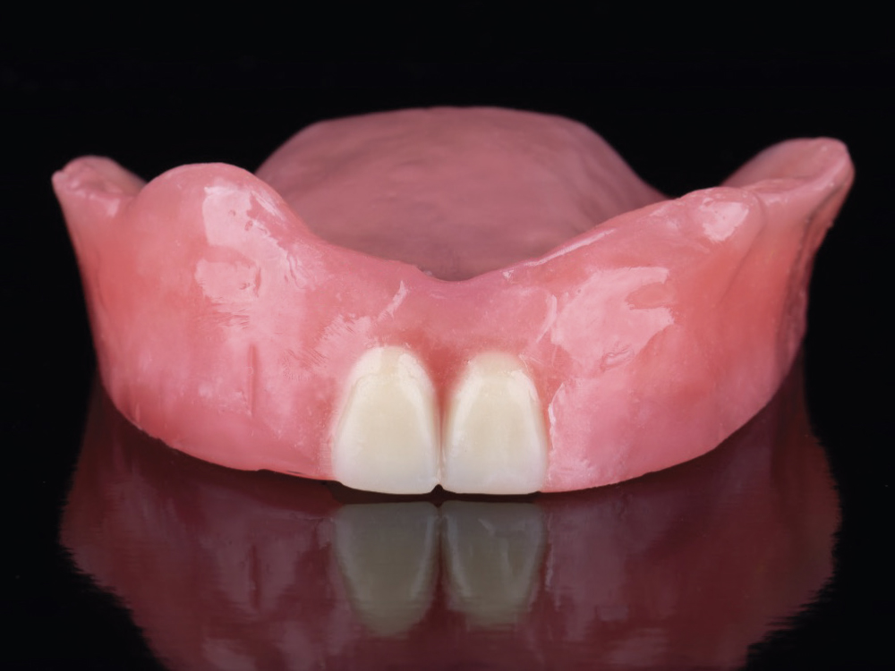Maxillary Complete Dentures FullArch Rehabilitation