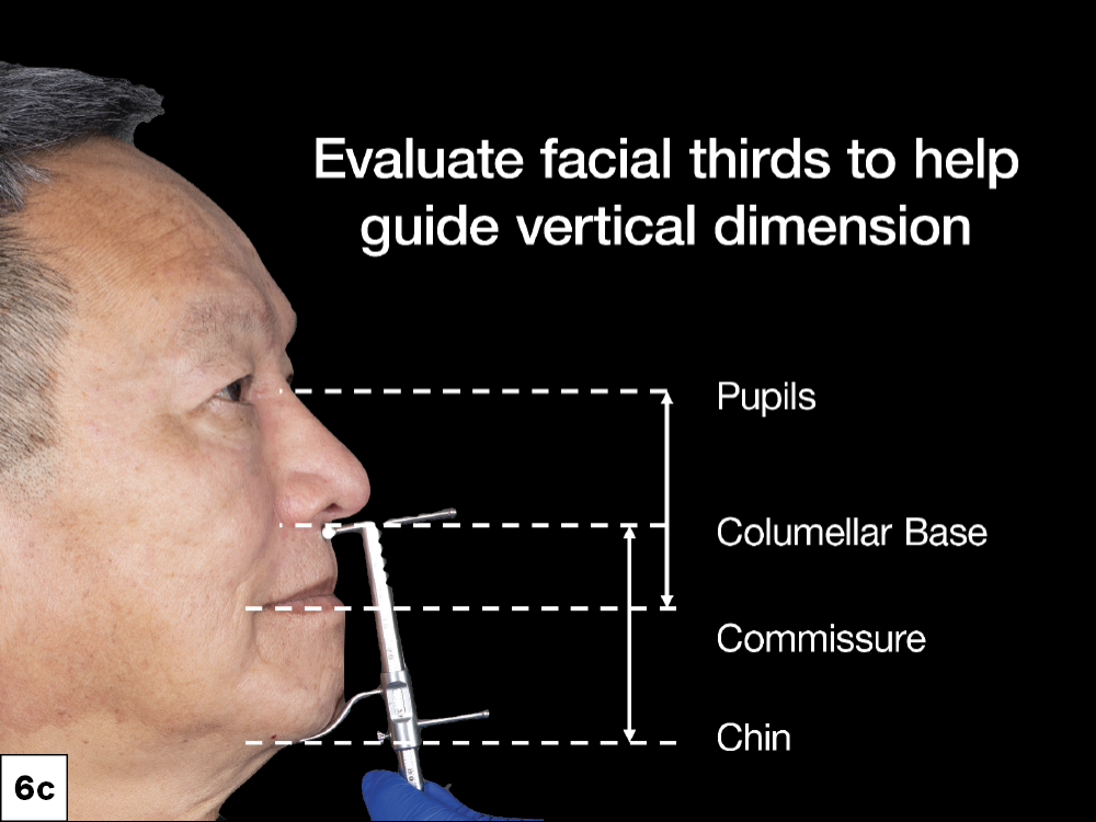 Evaluating facial thirds sectional summary