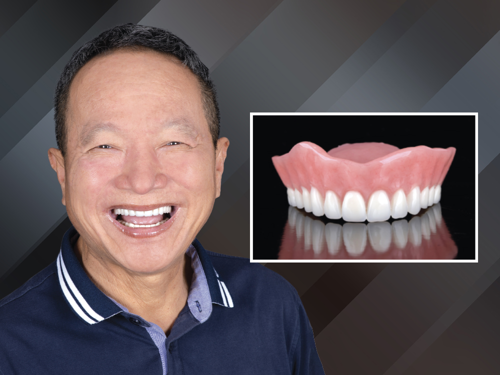 Maxillary Complete Dentures: Reestablishing Natural Tooth Position