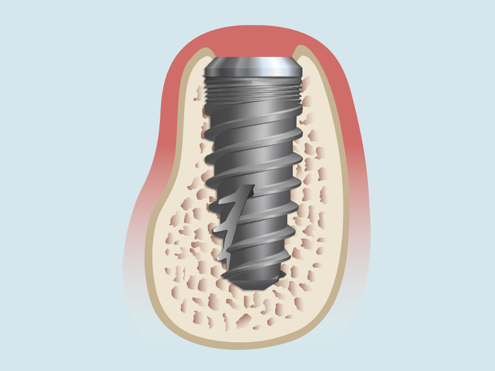 Image of an implant with the effect of cytoxic medications