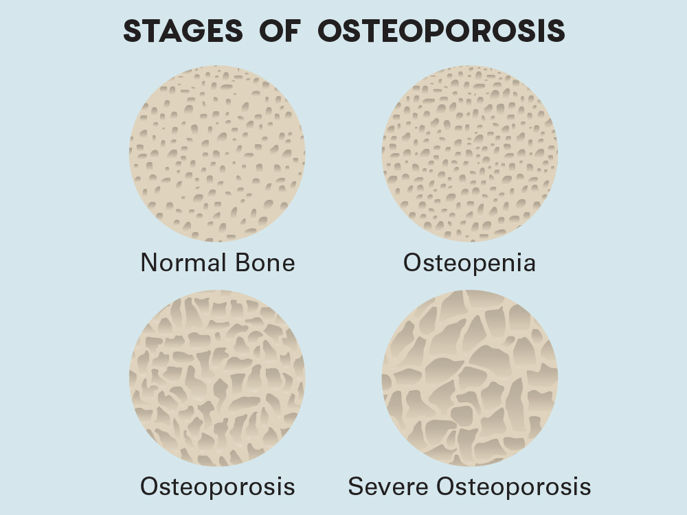 4 stages of osteoporosis 