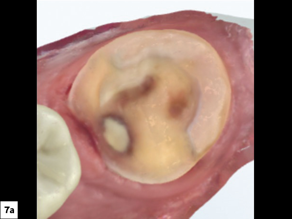 Figure 7a: First intraoral scan